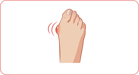 himitsu.04 外反母趾の進行を防ぐ